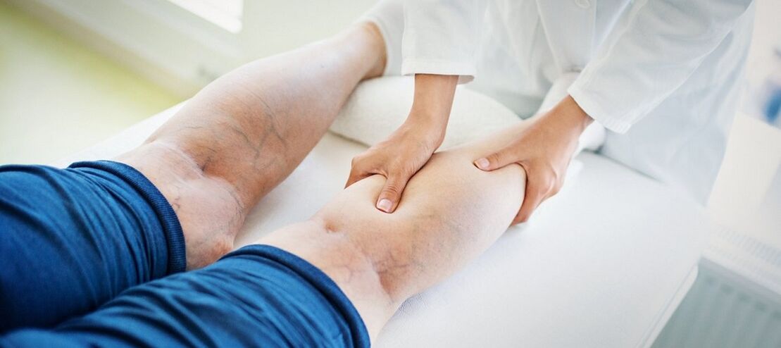 varizes nas pernas e seu tratamento