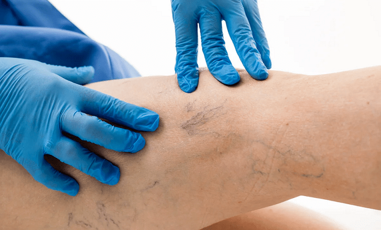 Malha vascular nas pernas é um sinal de veias varicosas
