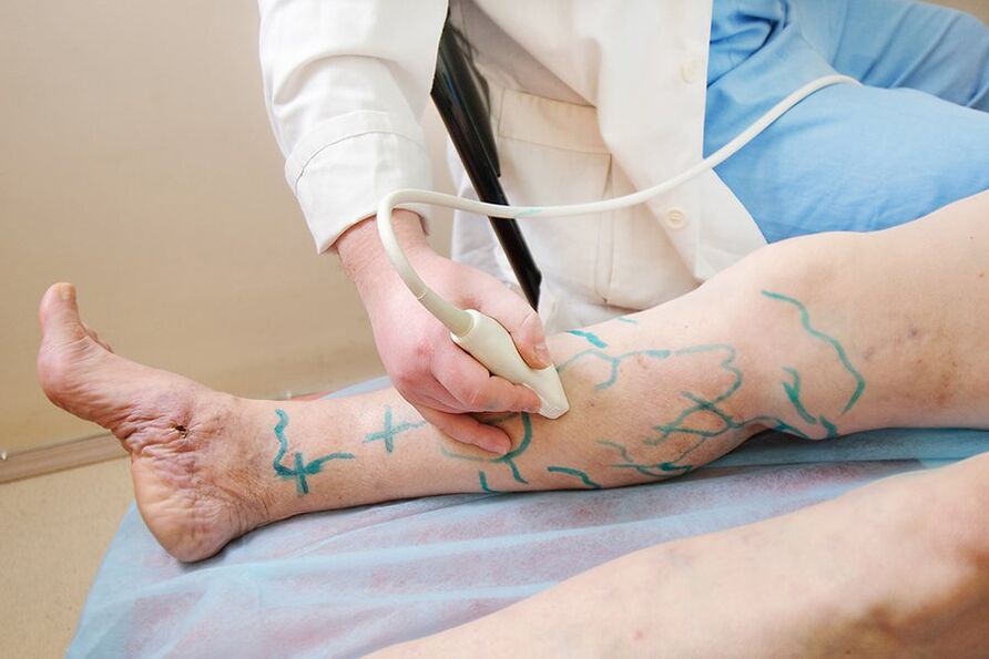Preparação para miniflebectomia - marcação nas perfurantes da perna, realização de ultrassonografia